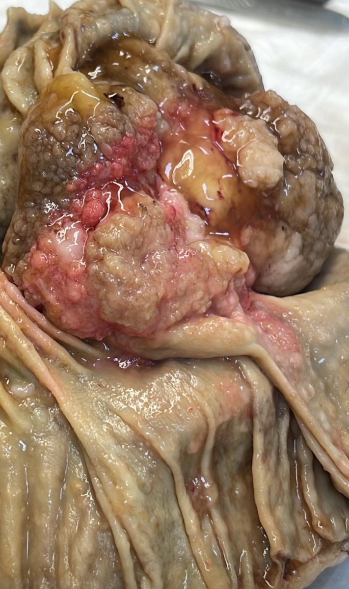ghadaesheba's tweet photo. The literal meaning of fungating/ cauliflower mass
#colon_cancer https://t.co/ERoRWZaVqp