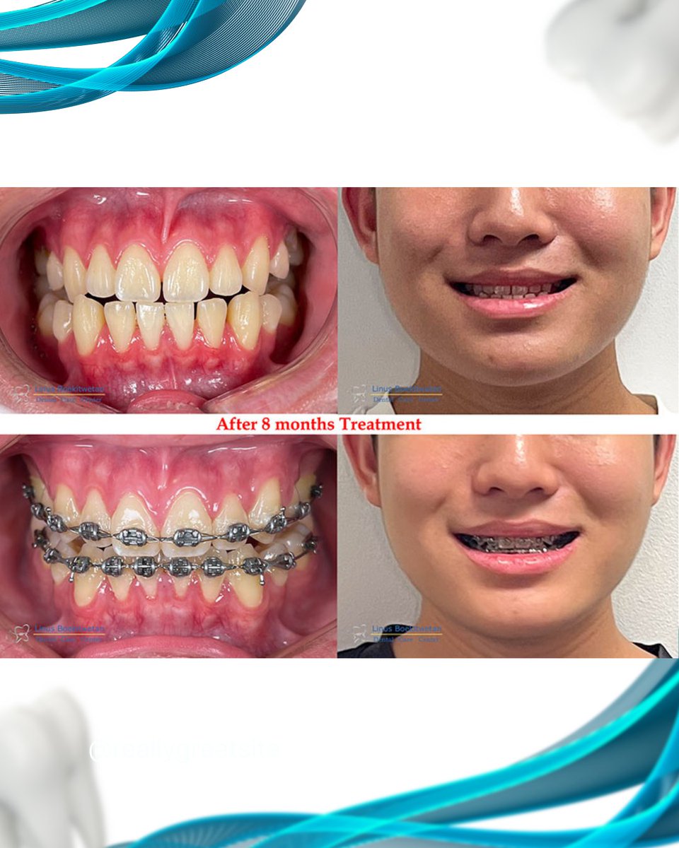 DrgLinus's tweet photo. Progress isn’t always visible, but it’s always happening 🫰🏻

#drglinus #braces #behelgigi #gigirapih #bracesprogress https://t.co/9LVhvfNGlX