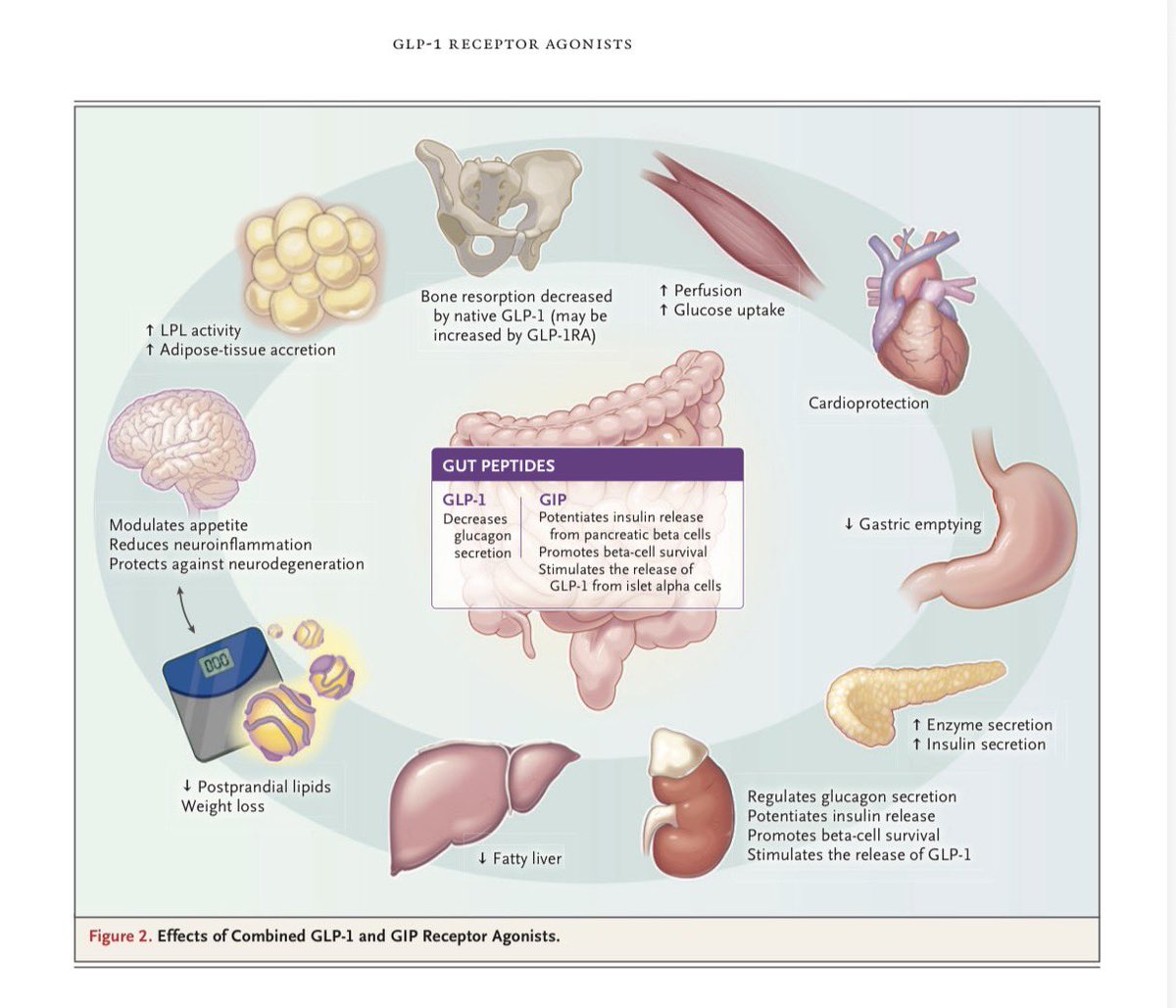 RheumattDoc's tweet photo. 🔬 GLP-1 Receptor Agonists: The Rise of GLP-1 Therapies

•Incretin analogues used in:

•Type 2 Diabetes Mellitus
•Obesity management

⚙️ Mechanism of Action
•↑ Glucose-dependent insulin secretion
•↓ Glucagon secretion
•↓ Gastric emptying
•🧠 Central effects (hypothalamus) → ↑ satiety → weight loss
•🦠 Gut microbiome modulation (emerging role)

✅ Clinical Benefits
•📉 Improved glycemic control
•⚖️ Significant weight reduction
•❤️ Reduced cardiovascular risk
•🧂 Slows progression of renal disease

⚠️ Adverse Effects
•Common:
•🤢 Nausea
•🤮 Vomiting
•💩 Diarrhea
•Others:
•💪 Loss of muscle mass
•🦴 Reduced bone mass

❗ Unresolved Questions
•Long-term adherence
•Weight regain after stopping therapy

•Functional impact of:
•Muscle loss
•Bone loss

🔭 Emerging Uses
•Ongoing research suggests potential roles beyond:
•Diabetes
•Obesity (e.g., metabolic, cardiovascular)

N Engl J Med 2026;394:1313–24
DOI: 10.1056/NEJMra2500106

#RheumattDoc #MedTwitter #RheumTwitter #Medicine #rheumatology @docakx @IhabFathiSulima @CelestinoGutirr @DurgaPrasannaM1