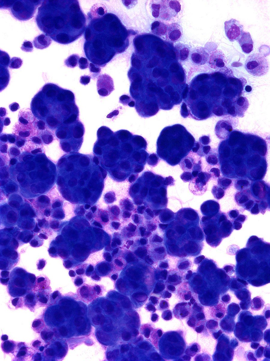 DrCycloPath's tweet image. Shipyard worker with berry-like 3D fragments and scalloped borders.

Diagnosis?

#PathQuiz 🔬🫁 #ThoracicPath
#Pathology