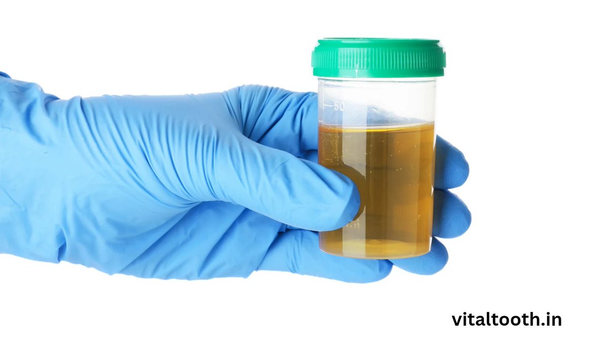 VitalTooth_'s tweet image. 🛑 “I don’t have time for a urine test.”

That’s what a gentleman with HIGH blood sugar told me during his #dental visit .

I said 👇🏻
👉 Instead of passing urine in the bathroom — pass it in a container. Submit to a lab.

His reply 👇🏻
“Everything is God’s will. We are nothing.”