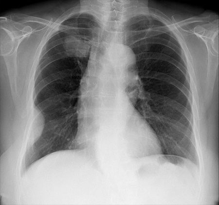 RadMasterclass's tweet image. CHEST X-RAY 71: Smoker. Describe the abnormalities. What is your diagnosis? Answer bit.ly/3Fab73G
