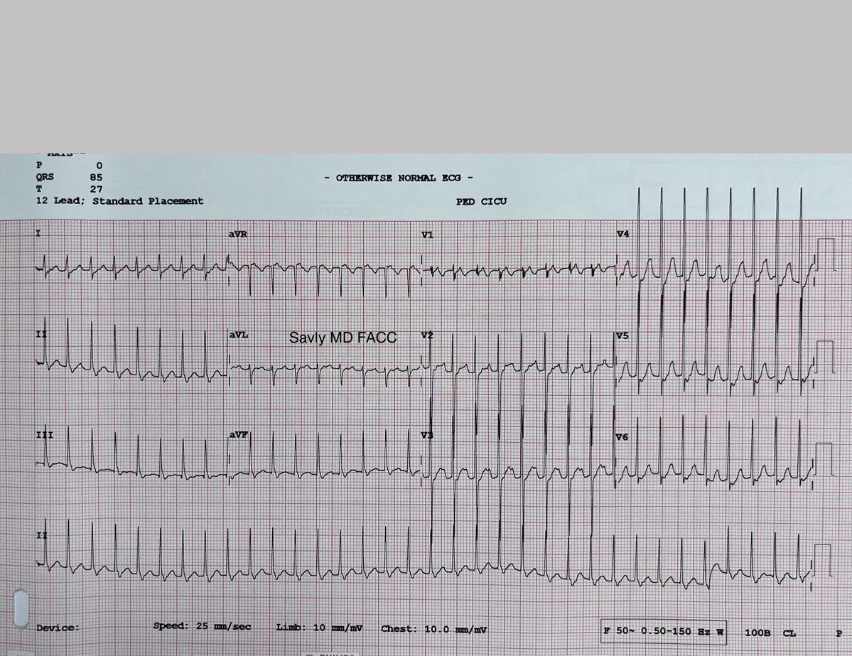 OungSavly's tweet image. 5-year-old child presented with complaints of a racing heart.
@jeffrey_vinocur @RobertHPass  @KaraMotonaga @iamritu @CASivaram1 @AEPCcongenital @SIwa23288585 @loomba_rohit @alex1708ander @ecgandrhythmRoe