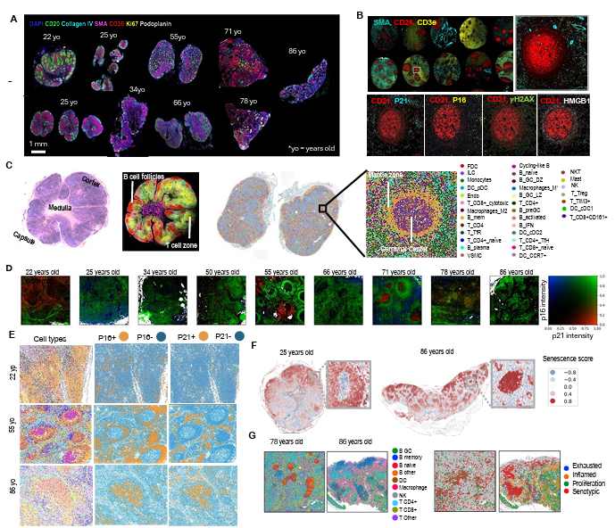 rust_ruslan's tweet image. Interesting new preprint mapping senescence across human lymph nodes from ages 18-100 using single-cell and spatial multi-omics. 

The authors found age-associated shifts in senescent cell location, moving from extrafollicular to germinal center regions. 

This spatial