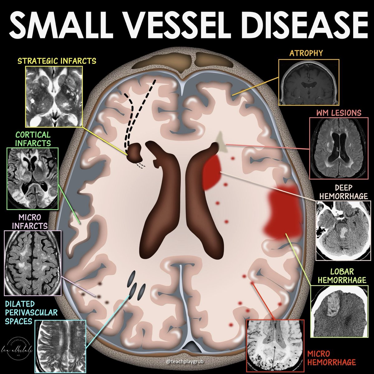 Lea Alhilali, MD tweet media