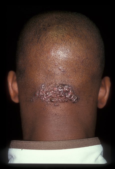 I’ve not seen this thing on the back of people’s head in a long while. What happened? How did we get rid of it?