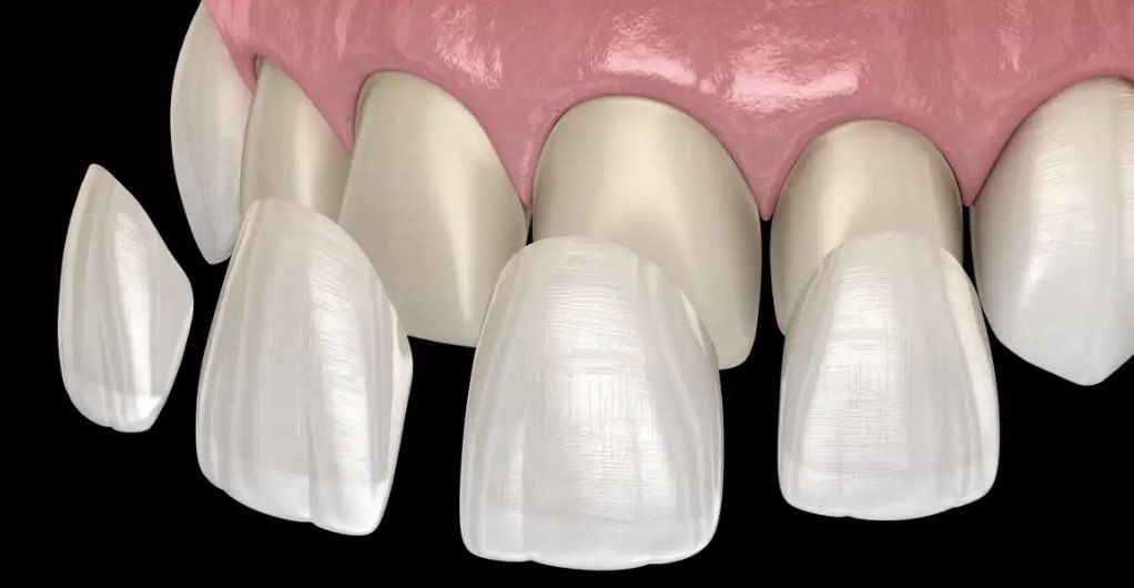 Alterdent's tweet photo. Veneers are a trend—but don’t rush. As an esthetic dentist, my advice:  irreversible sya &amp; require shaving natural teeth. It’s a lifetime commitment of maintenance—and not to mention, expensive.

If you have a good set of teeth, consider whitening or other options first. 🦷 https://t.co/4aEi9AMcxU