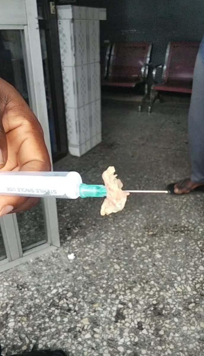 Medzonetv's tweet image. A 24-year-old House Officer is performing an emergency paracentesis on a patient with advanced liver cirrhosis. 🏥

The patient is restless, the ward is dimly lit, and the tension is high.

As the HO withdraws the 18G needle, the patient suddenly jerks.

The needle pierces the