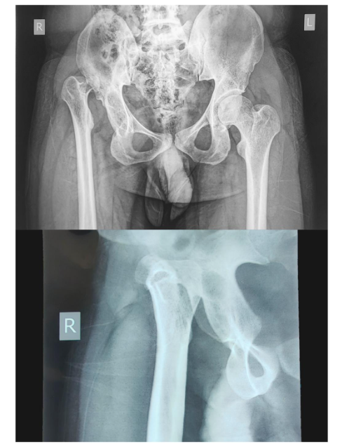 jbjs's tweet photo. "Robotic-Assisted Total Hip Arthroplasty in Combined Short Stature and Crowe-IV Developmental Hip Dysplasia" by Mane et al.

Click the🔗 to read the full article 👉 https://t.co/lDdQ8O4mFJ

#JBJS #CaseConnector https://t.co/NsxqS8gfeJ