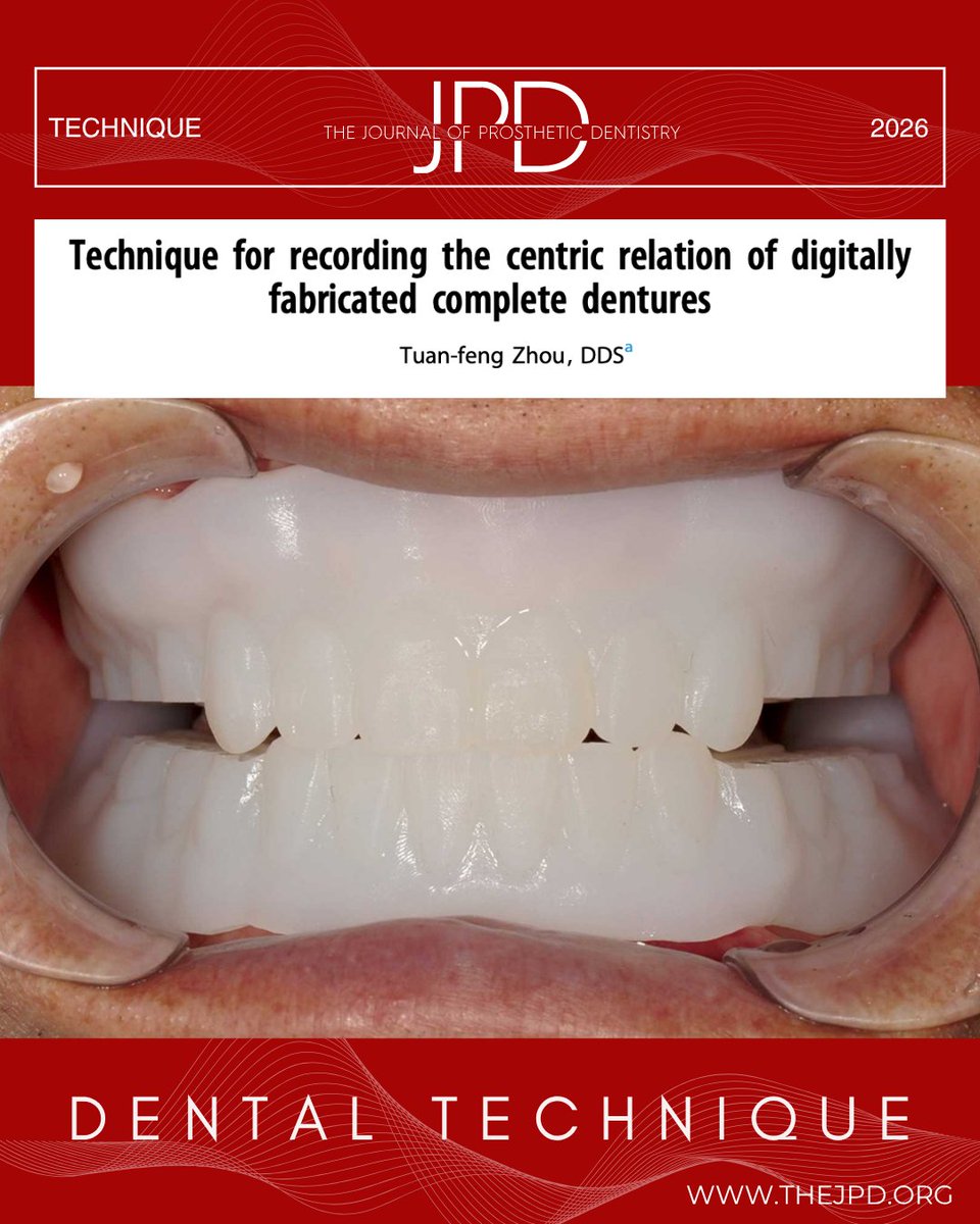 JPDentistry's tweet image. #TechniqueTuesday - This #technique utilize a #printed gothic arch tracing that is incorporated into the evaluation denture, allowing for the ability to verify OVD, stability of the bases, and #centricrelation. thejpd.org/article/S0022-…