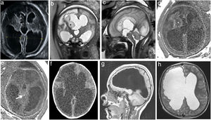 RevistaRADIOLO2's tweet photo. Este año ha comenzado la serie de RM fetal. El primer artículo repasa la RM en la ventriculomegalia cerebral fetal. ¡No te lo pierdas!
https://t.co/zi3z07WM55
English version: https://t.co/lCI1JXPcop https://t.co/jEYyiH8AxN