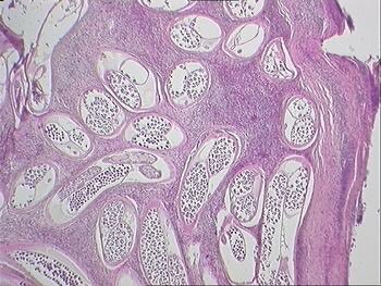 alaboudkhalid's tweet photo. ⁦@RitchaSaxena⁩ @feldstej @guerreroespejo@ilovepathology ⁦@ParasiteGal⁩ @iheartpath @mvmd0908 ;identify this parasitic structure &amp; win.Check your answer &amp; Prize with @DrGeeONE 
Double barrel uterus,in #Onchocerciasis /#onchocercoma caused by Onchocerca volvulus)#worms https://t.co/DDFk3JqAMi