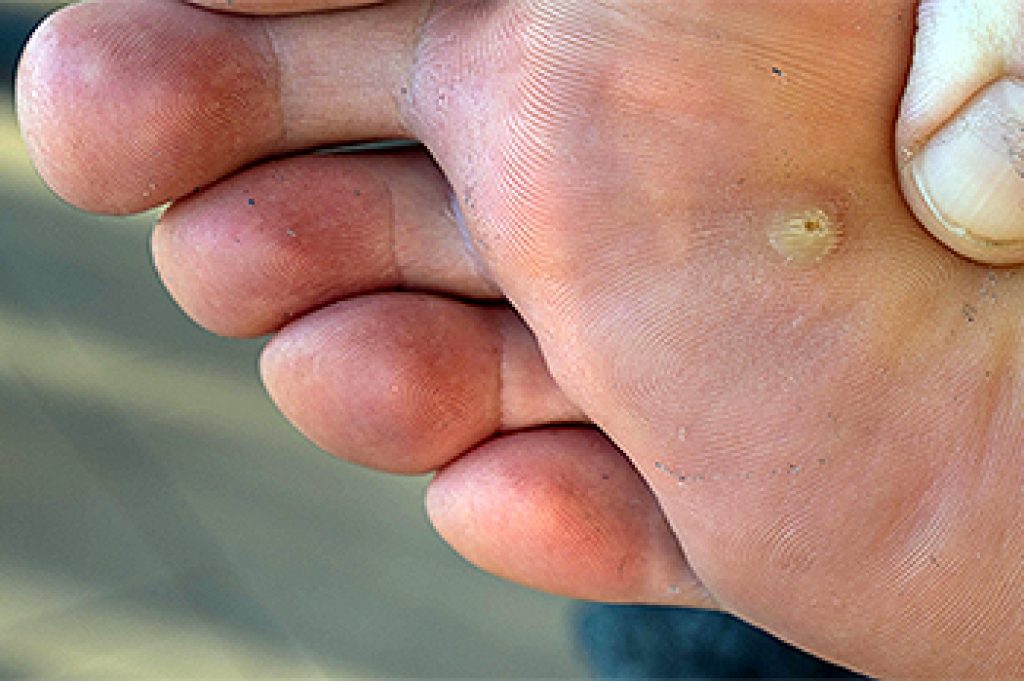 advanced_ankle's tweet photo. Dealing With Warts on the Feet https://t.co/Vw3lR0Iclp https://t.co/njRKVpc0cc