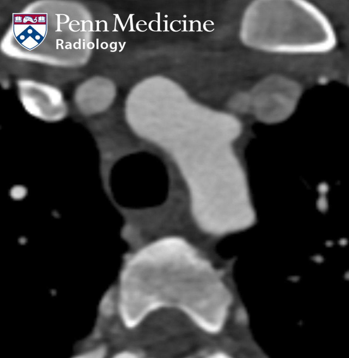 AuntMinnie's tweet image. How would you diagnose this case? 28-year-old woman screened for aortic dissection #radiology buff.ly/YU2FgH7