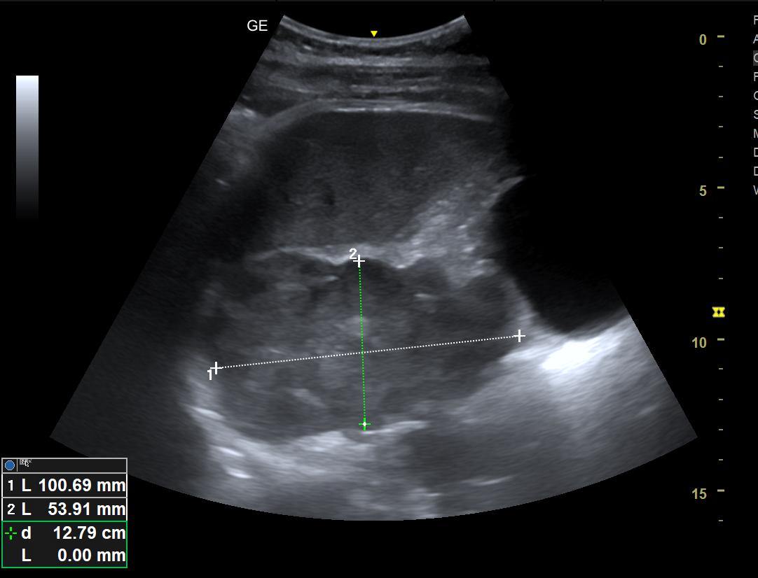PierpaDiNick's tweet image. Today's #Pocus quiz for everybody:
"Doc, I' ve got some pain in the right flank" 
What are we seeing here?