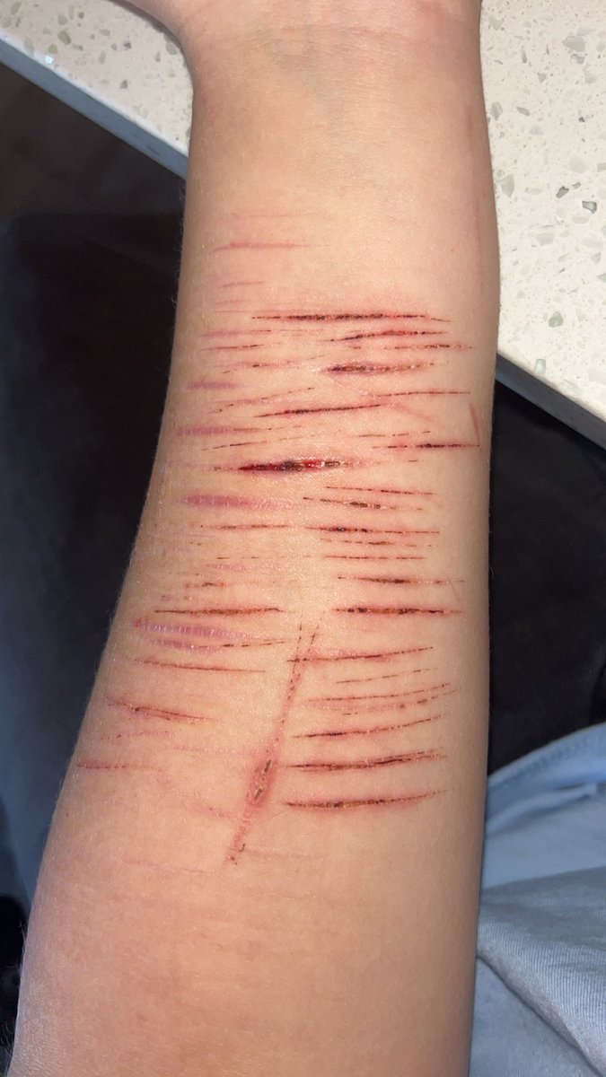 how my cuts are healing so far!!! :-) #shtwt #slittwt