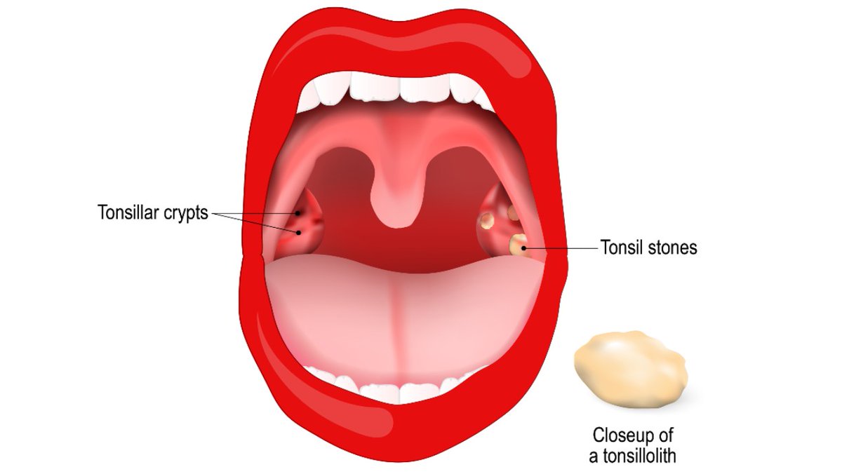 PositivemindH's tweet image. Post by Dr Sagar Rajkuwar – ENT Specialist Doctor, Nashik, India

👅 White stones on tonsils? Often tonsil stones causing bad breath &amp;amp; discomfort.

📖 Full medical explanation here 👇
 healthuseful.com/tonsillitis-wh…

#Tonsillitis #TonsilStones #ENTDoctor #HealthTips #ThroatCare