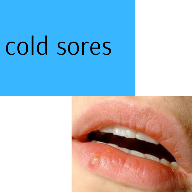 Cold sores are the result of a viral infection otherwise known as Herpes Simplex. Symptoms consist of itching, burning blisters, usually on the lips but may also be inside the mouth or nostrils or on the chin or cheeks.  owenhomoeopathics.com.au/free-informati…