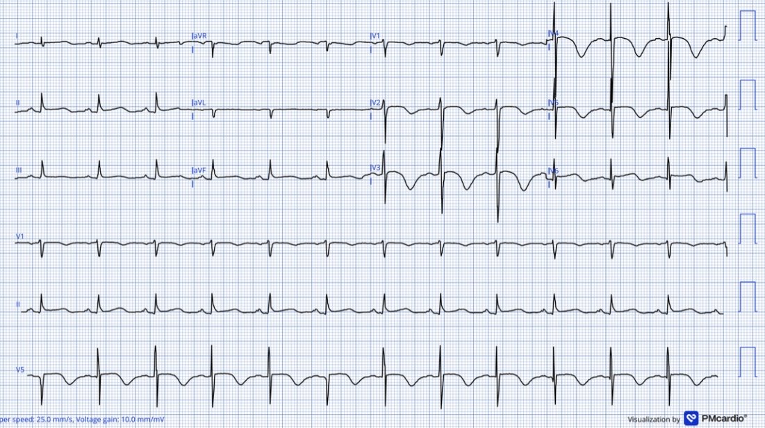notkillingeve's tweet photo. Middle-aged male on day 2 of withdrawal from opioids. What’s your diagnosis? (1st EKG prior to admission, 2nd at time EKG changes noticed, 3rd 6 hours later w/ acute hypotension) @ecgandrhythmRoe @ECGwithReid @emcrit @cliffreid https://t.co/c1XIYxFgDm