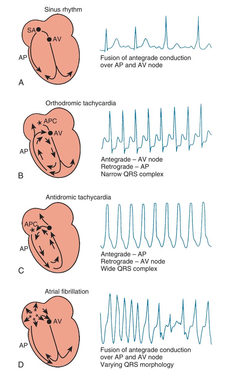 Possible rhythms in Wolff-Parkinson-White (WPW) syndrome.
Schematic representation of possible rhythms in a patient with an accessory atrioventricular (AV) bypass tract.

A. During sinus rhythm, the ventricle may be activated by conduction over the accessory pathway (AP) and