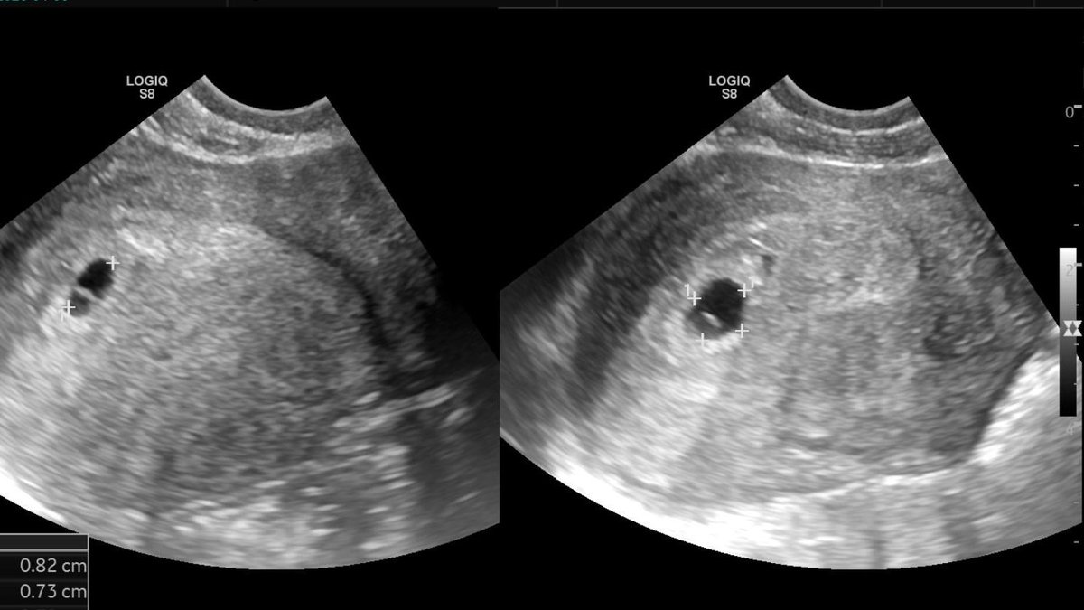 sxzz's tweet image. 移植成功，六周的第一次超声波影像。辛苦老婆 @mieisgood
我要当爸爸了！