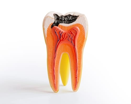 Dr. Matthew Keider explains when a root canal is necessary to treat an infection caused by bacteria entering the inner chamber of a tooth. bit.ly/3Kms00A #KeiderDDS #WinstonSalem #NorthCarolina