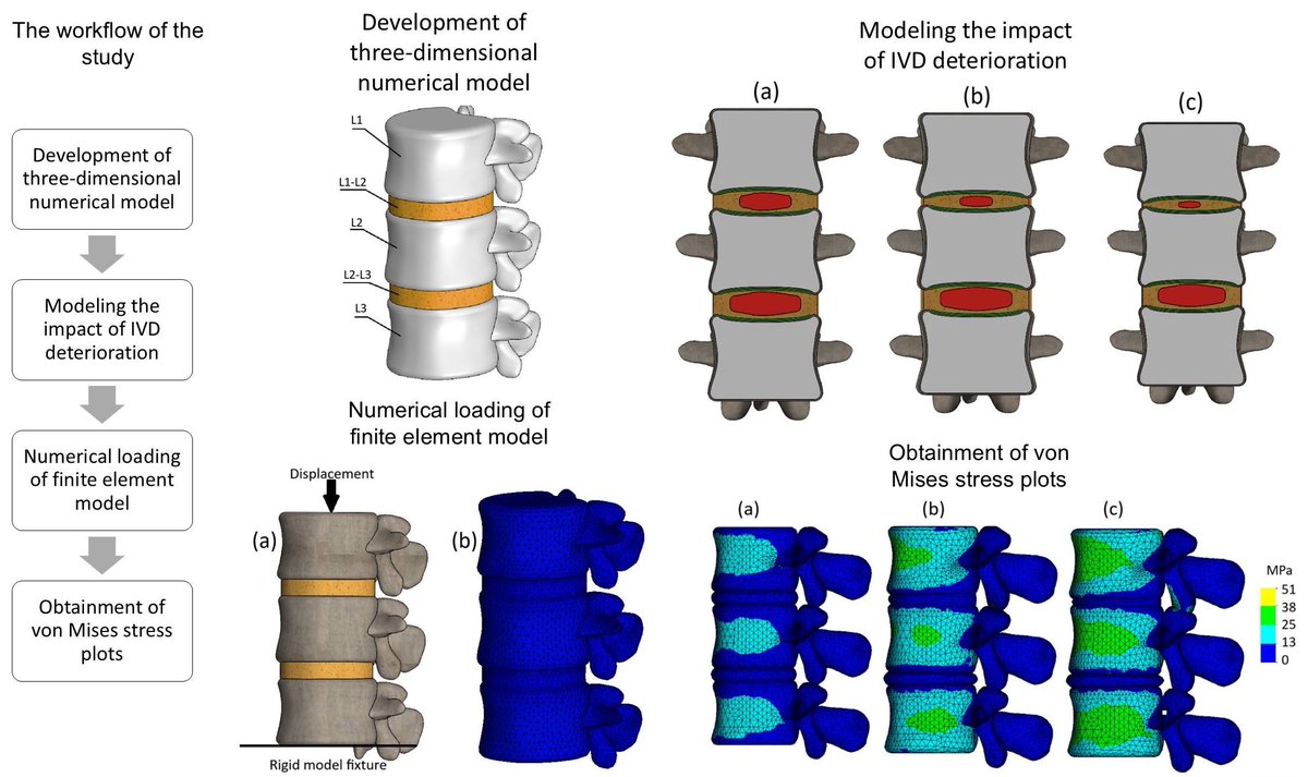 Bioeng_MDPI's tweet photo. π₯Excited for the publication: "Parametric Finite Element Evaluation of Load Redistribution Under Progressive Lumbar Disc Degeneration"
π https://t.co/M2hf4mUQhB
π« @VU_LT
π #annulusfibrosus #degenerativespinaldiseases #finiteelementmethod https://t.co/OCdhiQRDmB