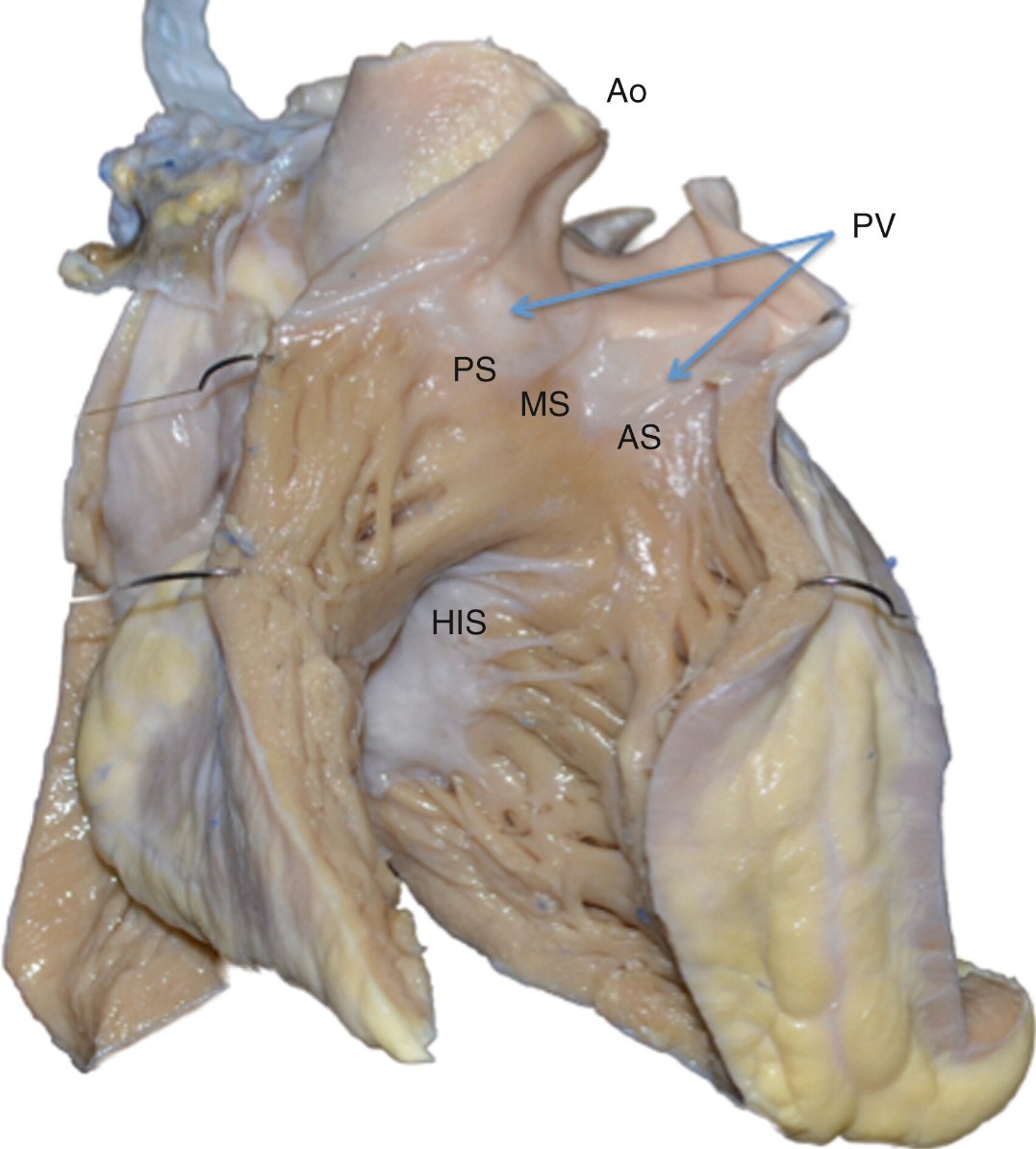 TrackYourHeart's tweet photo. Anterior view of the human heart, with the free wall of the right ventricle cut open. https://t.co/dGrBZy6vjr