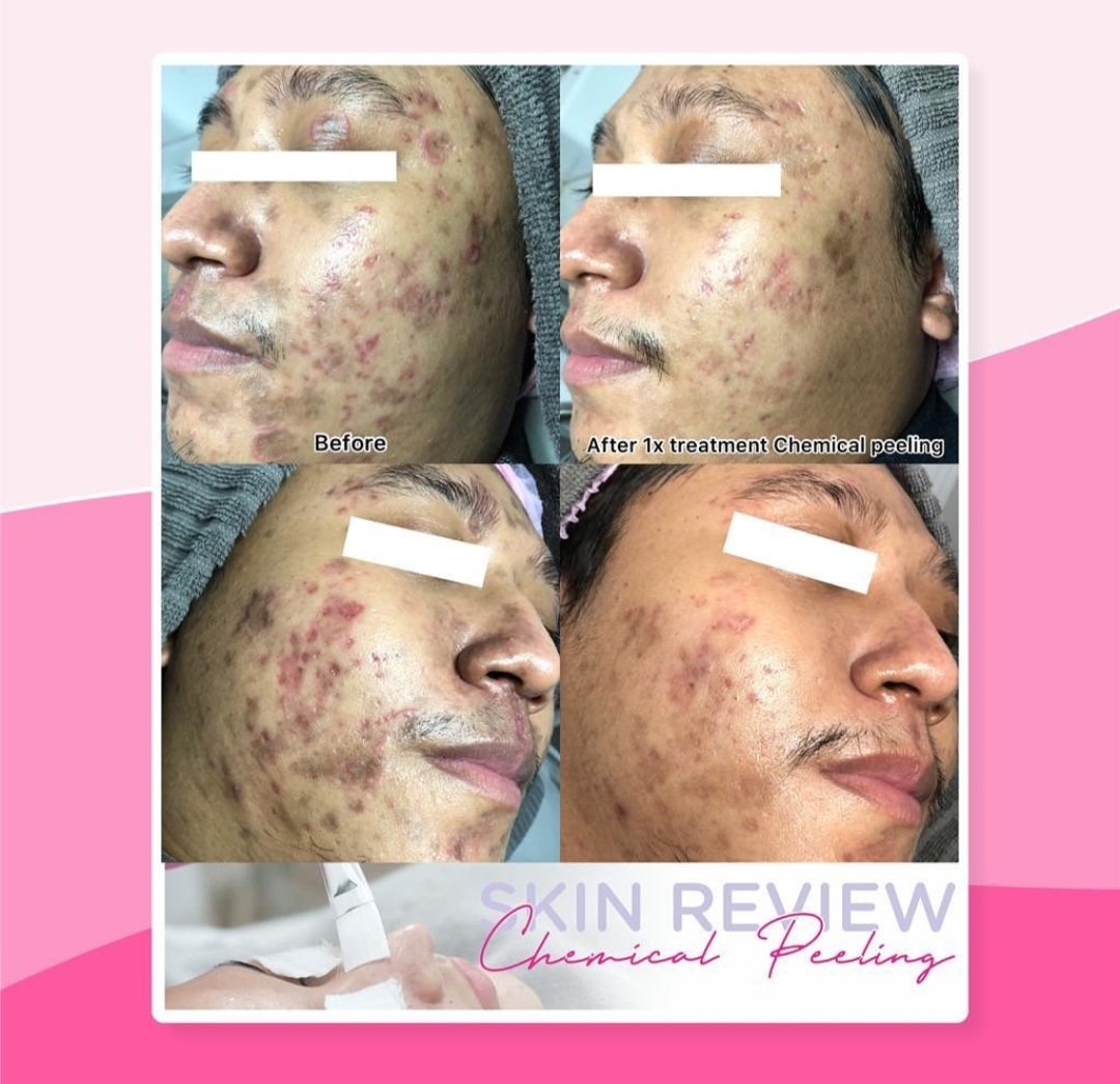 cipakcipik's tweet image. #TriggerWarning
[Gambar bisa jadi agak sensitif]

PERMASALAHAN KULIT

Jujur bingung itu awalnya gimana. Bukan jerawat tapi kayak bercak banyak dan ngumpul. Bikin bopeng pula.

Nangis sih pernah ya karena malu banget kulitnya parah dan bingung diapain.

Beraniin ke dokter