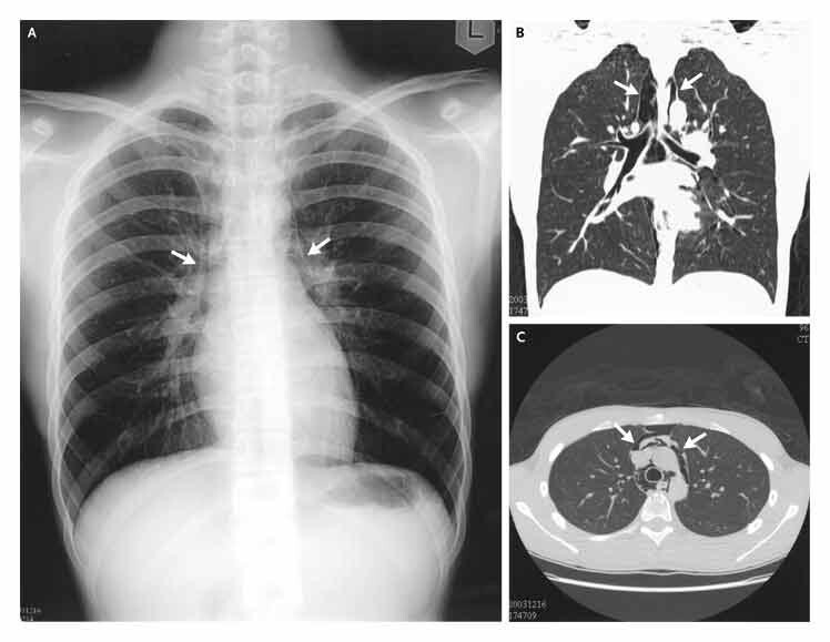 drsthanus's tweet photo. Pneumomediastinum

The chest radiograph shows clear lungs, pneumomediastinum and pneumopericardium without evidence of rib fracture or pneumothorax.

Panel A

Clear lungs, pneumomediastinum (arrows), and pneumopericardium without evidence of rib fracture or pneumothorax. 

Computed tomography of the chest (Panels B and C).

 Subcutaneous emphysema of the neck, pneumomediastinum (arrows), and pneumopericardium.

https://t.co/RDFLp8anX8