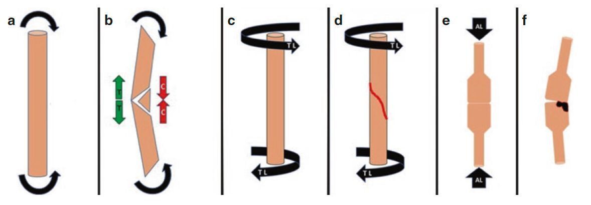 MoAImam's tweet image. Fracture Patterns by Loading Type
(a–b) Bending load → split wedge fracture (compression side vs tension side)
(c–d) Torsional load → helical fracture pattern
(e–f) Axial load → joint compression fracture