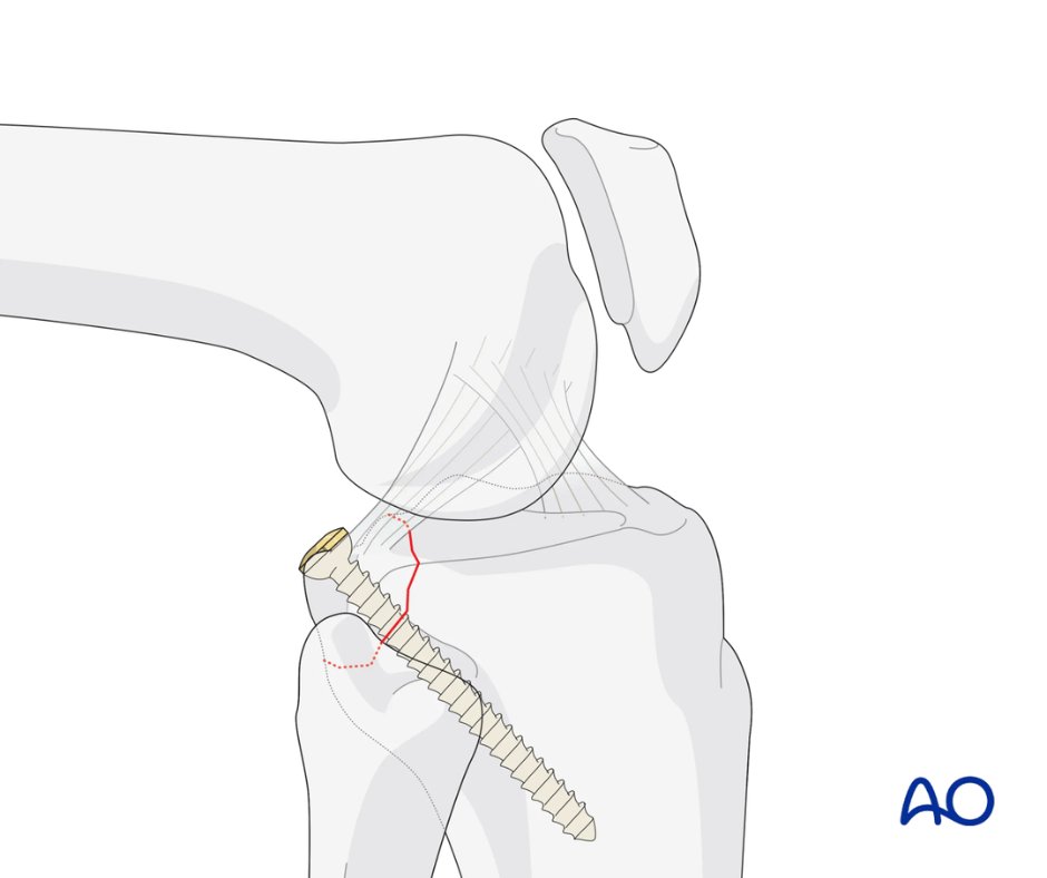 AOSurgery's tweet photo. 📢 Now live: the fully revised AO Surgery Reference – Adult Trauma, Proximal Tibia module

Updated by an international team of experts, this module provides the latest evidence-based, clinically relevant guidance for managing proximal tibia fractures.

🔗 https://t.co/wp0ROvcuZQ https://t.co/diQZhSiEOI