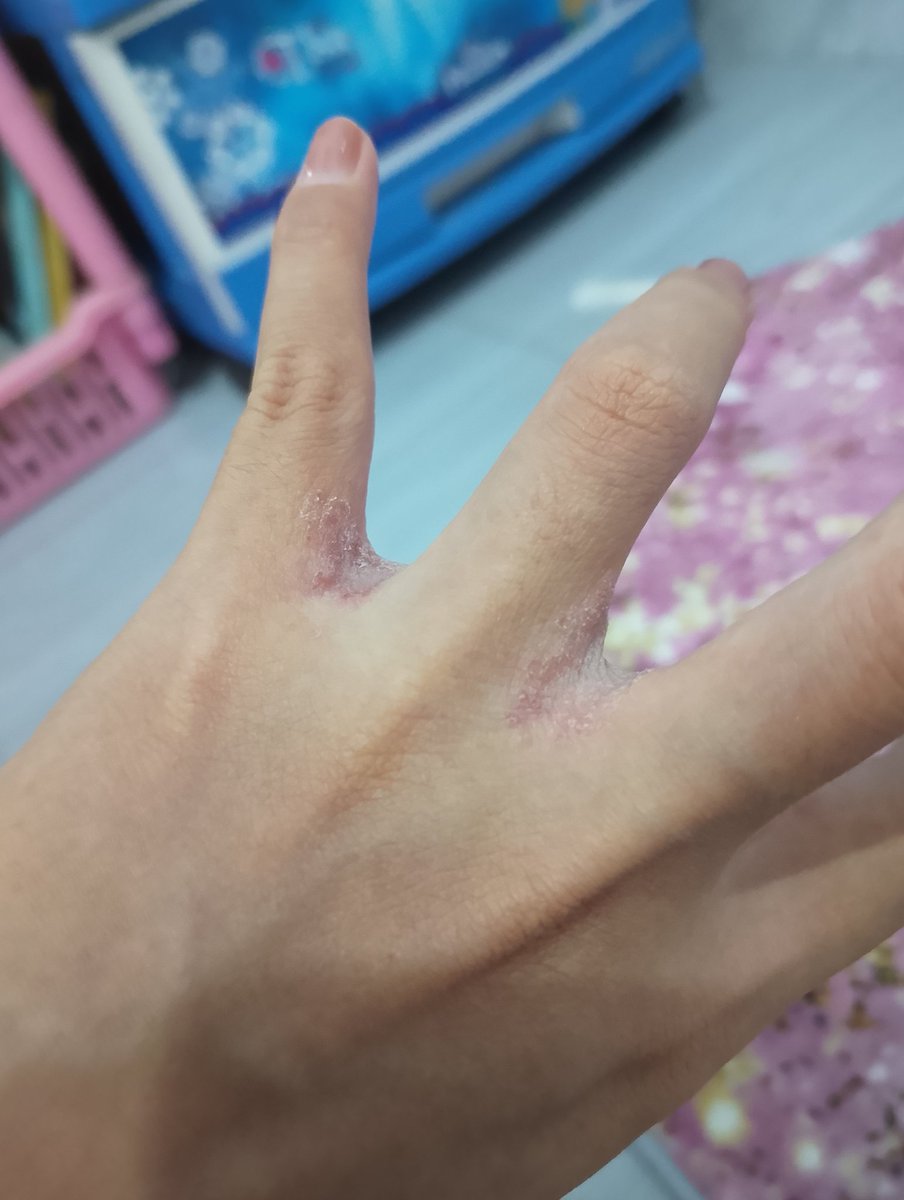 almssyzyni's tweet photo. Iritasi karena sabun, lotion, makanan ❌
Iritasi karena pake cincin emas muda ✅ https://t.co/i419RoWoNh