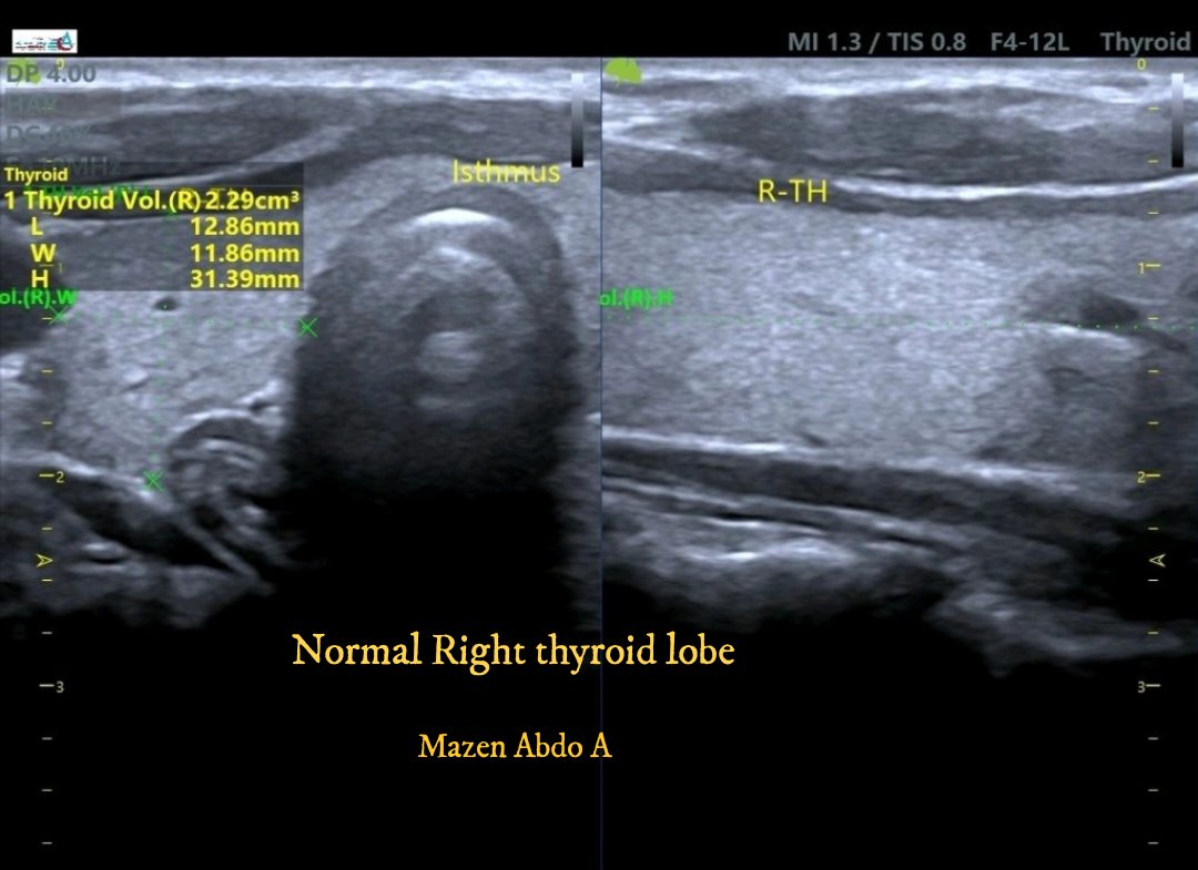 mznljrdy47597's tweet image. Ultrasound cases  from my  daily practice .
Right  lobe and isthmus are normal in size, shape and structure. No  solid or cystic mass lesion .
Left  lobe of the thyroid gland relatively enlarged  in size,  and  show multiple  solid nodules ,MNG 
#Ultrasound #Sonography #Radiology