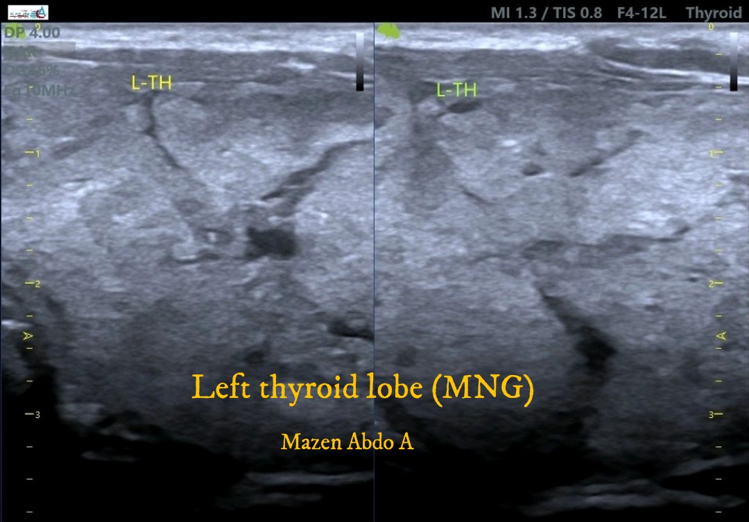 mznljrdy47597's tweet image. Ultrasound cases  from my  daily practice .
Right  lobe and isthmus are normal in size, shape and structure. No  solid or cystic mass lesion .
Left  lobe of the thyroid gland relatively enlarged  in size,  and  show multiple  solid nodules ,MNG 
#Ultrasound #Sonography #Radiology