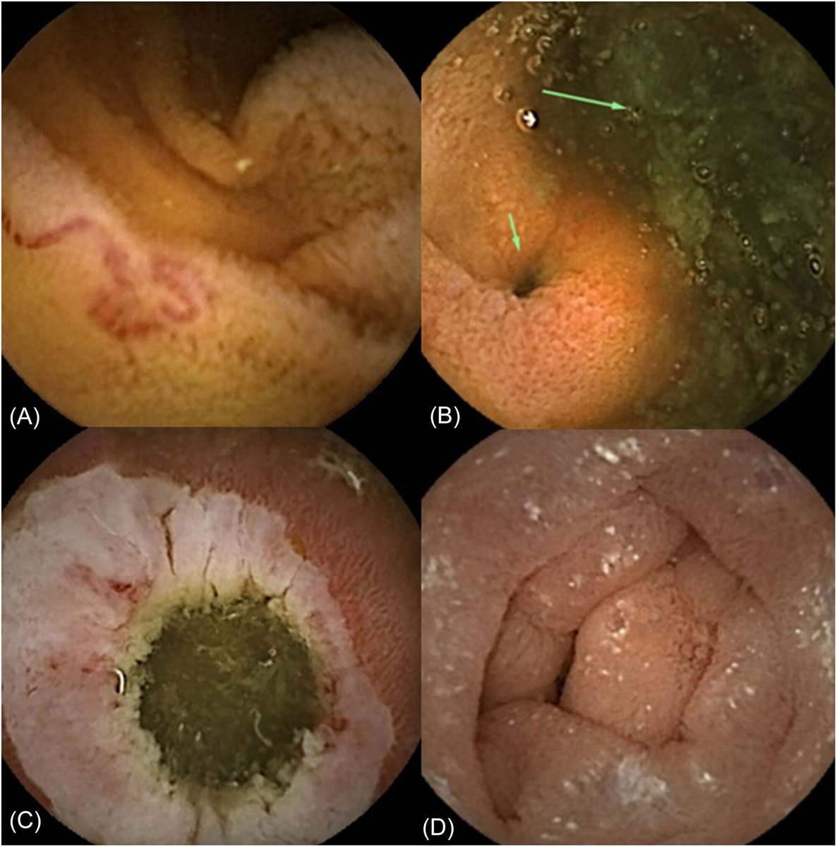 JPGNonline's tweet image. 📹 Pediatric capsule endoscopy:

• 51% diagnostic yield
• 35% changed management

But ↓ yield in isolated abdominal pain

Right test, right patient matters.

🔗 doi.org/10.1002/jpn3.7…

#pediatrics #pedsgi #Endoscopy #cme