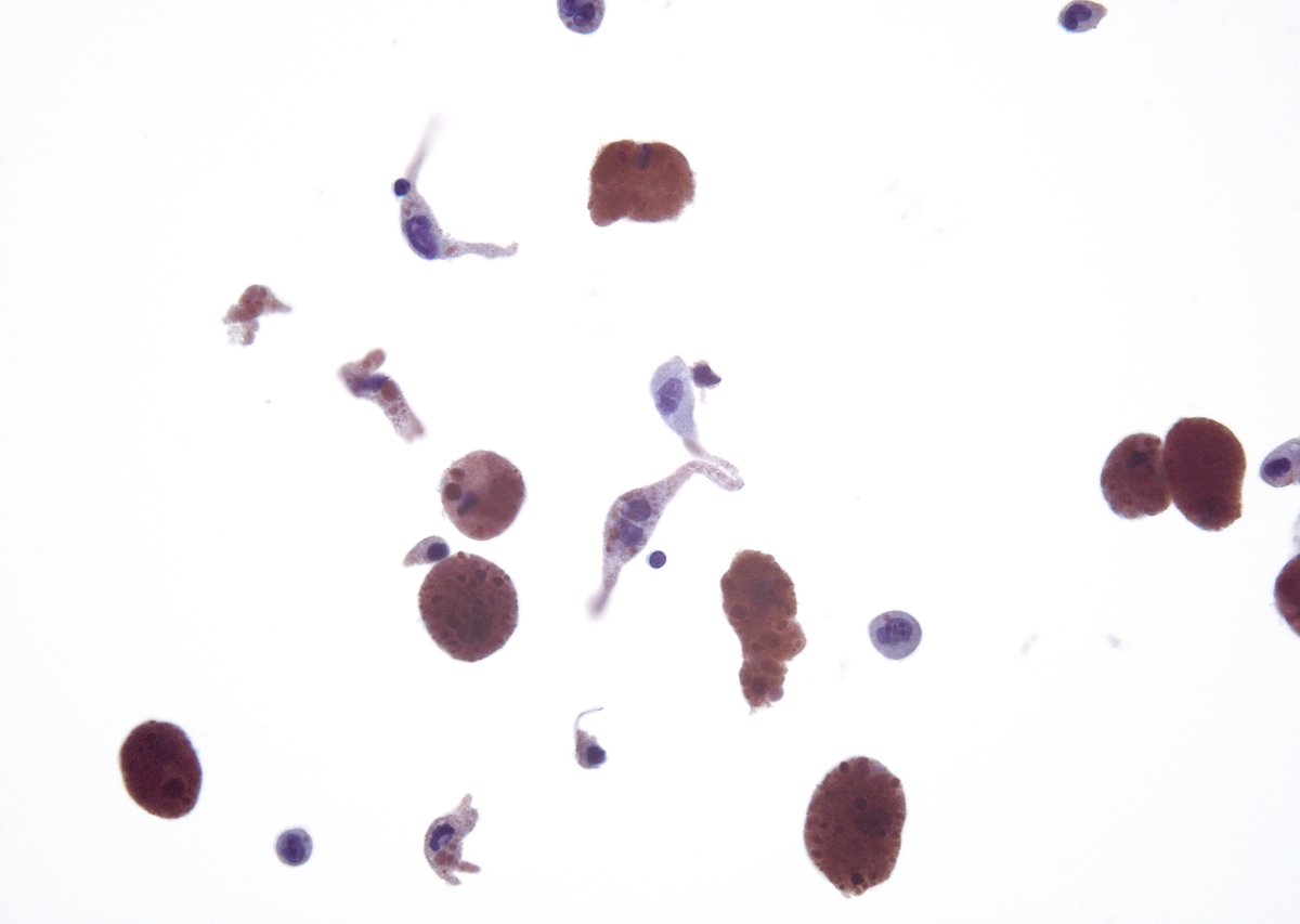 sza_jhcyto's tweet photo. Just a wild case - Parotid FNA in a patient with a recent history of H&N squamous cell carcinoma. Cytomorphology as shown here (spindled cells with long cytoplasmic tails and melanophages), is consistent with "Malignant Melanoma". IHCs on the cell block confirmed the dx. Primary salivary gland melanoma is exceedingly rare (< 0.7% of all salivary gland malignancies). A careful investigation will be needed in this case to exclude mets to the parotid. (ThinPrep)