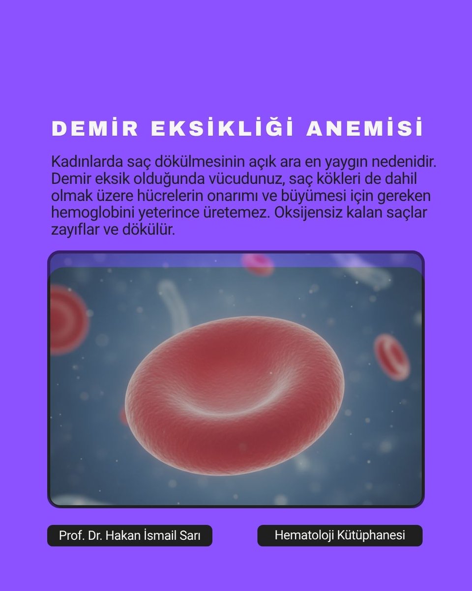 profdrhisari's tweet photo. Saçlarınız Neden Dökülüyor?
Saç dökülmesinin stres, genetik veya mevsimsel olduğunu düşünebilirsiniz. Ancak kadınlarda çoğu zaman asıl suçlu, kan değerlerindeki eksikliklerdir.

1. Demir Eksikliği Anemisi (Kansızlık)
Kadınlarda saç dökülmesinin açık ara en yaygın nedenidir. Demir eksik olduğunda vücudunuz, saç kökleri de dahil olmak üzere hücrelerin onarımı ve büyümesi için gereken hemoglobini yeterince üretemez. Oksijensiz kalan saçlar zayıflar ve dökülür.

2. B12 Vitamini Eksikliği
Sağlıklı kırmızı kan hücrelerinin üretimi için B12 vitamini şarttır. Kırmızı kan hücreleri vücudumuzun her yerine oksijen taşır. B12 eksikliğinde saç folikülleri ihtiyaç duydukları besini alamaz ve saç döngüsü sekteye uğrar.

3. Çinko ve Folik Asit Eksikliği
Çinko, saç dokusunun büyümesinde ve yağ bezlerinin düzgün çalışmasında kritik rol oynar. Folik asit ise hücre yenilenmesini sağlar. Kan tahlilinde bu değerlerin düşük çıkması, saç tellerinin zayıflamasına ve koparak dökülmesine yol açar.

Çözüm İçin Ne Yapmalısınız? 
Hemogram, Ferritin (Depo Demir), B12, Çinko ve Folat değerlerinizi kontrol ettirin.

#profdrhakanismailsarı #Hematolojiistanbul #kandeğerleri #saçdökülmesinekarşı #saçdökülmesineçözüm
                 https://t.co/puPPWNlVQc