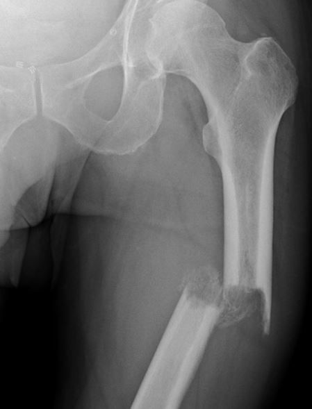 RadMasterclass's tweet image. TRAUMA X-RAY 21: Low force trauma. How would you describe this injury and what is your concern? Answer bit.ly/3SrH38w