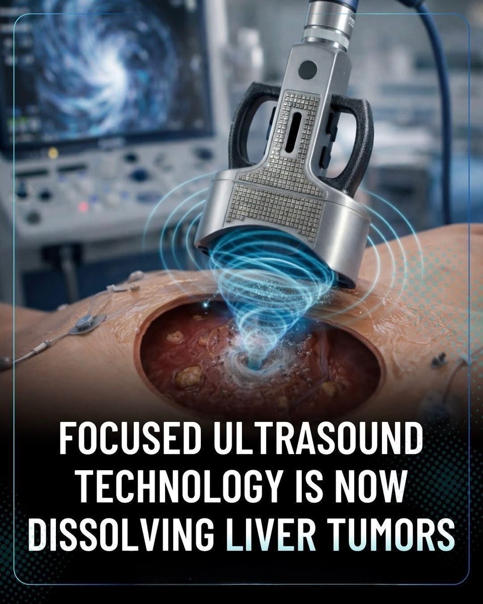 scitechgirl's tweet image. 🧬 Tumors Dissolve Without Surgery!

From the lab of top researchers, a new technology is changing cancer treatment. Focused ultrasound uses powerful sound waves to break liver tumors apart—turning them into tiny fragments your body can clear. No cuts, no radiation, just precise