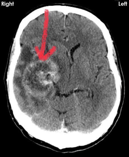 DrAyubaD's tweet image. 40 yr old woman with previous mastectomy.

Now presents with recurrent headache and an episode of seizure.

What lesion is shown by the RED arrow?

#Radres #MedX #Radiology #Neurorad