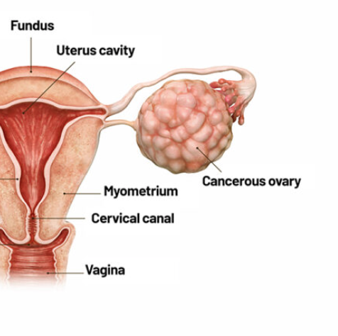 AB_drmd's tweet image. 🚨🚨🚨الثلاثي هذا يدل على اي متلازمة؟
- Solid ovarian tumor
- Ascites
- Pleural effusion