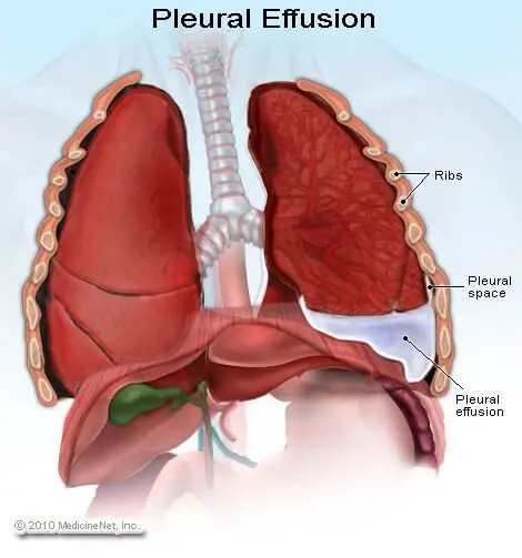 AB_drmd's tweet image. 🚨🚨🚨الثلاثي هذا يدل على اي متلازمة؟
- Solid ovarian tumor
- Ascites
- Pleural effusion