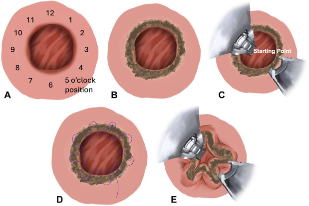 GIE_Journal's tweet photo. In Focused Communications, McCarty et al record "Establishing standards of practice for transoral outlet reduction: an expert consensus using a modified Delphi method." https://t.co/IKt18a95m6

#GITwitter 

@SighPichamol https://t.co/ZxoFcJh72E