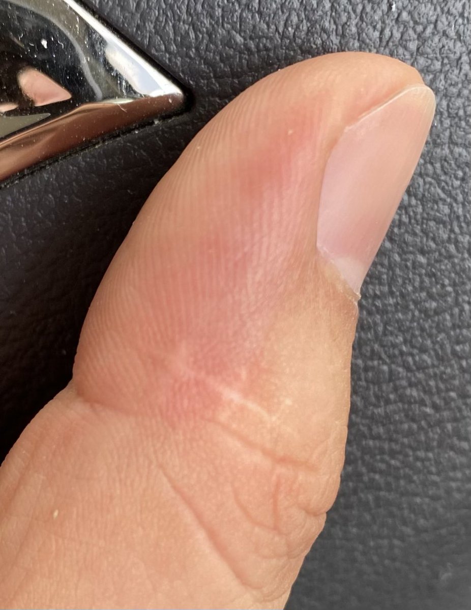 左手親指に羂索がいるお

昔カッターでガッツんやった時の傷なだけだけども〜🤣