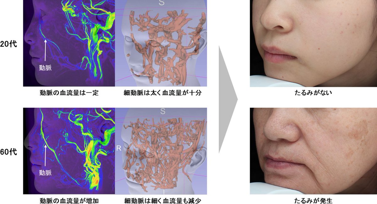 PRTIMES_BEAUTY's tweet photo. 資生堂、加齢による深部血管の血流バランスの崩れが肌のたるみを引き起こすことを発見　～「べにばな」由来エキス... https://t.co/qnJthhgda4 https://t.co/DW600HhfHD