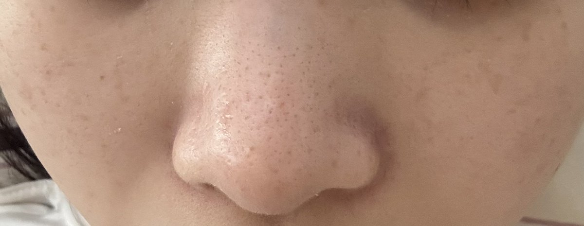 mer_pon2's tweet photo. こんな感じのそばかす？を完全に消すにはどうしたらいいの😰ルメッカはすでに4回やってるけどやっぱりルビーフラクショナルのほえがいい？
あと鼻の黒ずみ気になる、、、、 https://t.co/AEYWEKMTdb