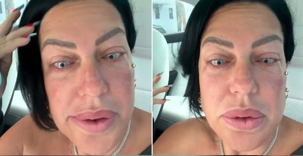 La autodenominada "Diosa", acaba de operarse los ojos porque "quería un tono más claro", y se le ocurrió que para monetizar podía compartir todo el proceso con "sus seguidores". Su "payasada" permitió ver como pagó 8.000 dólares para ser mucho más fea que antes.
