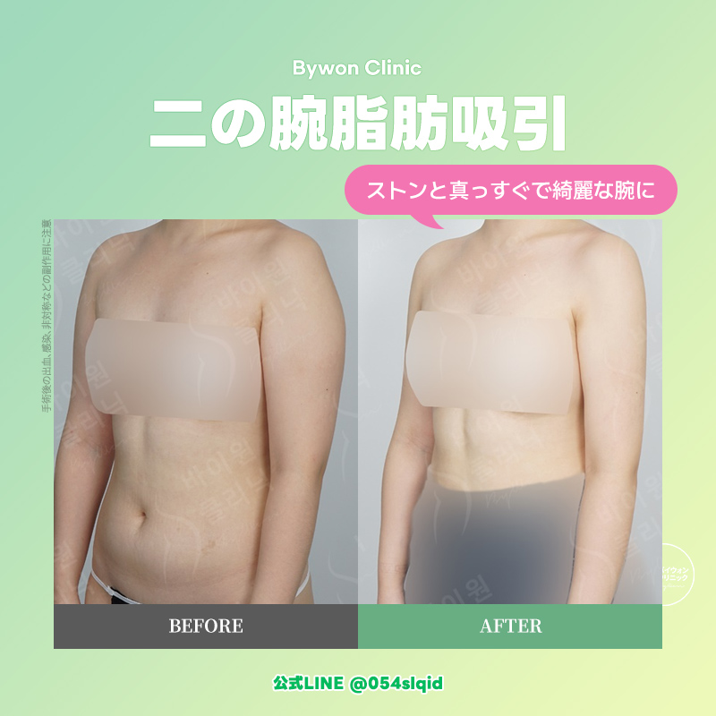 【韓国脂肪吸引専門】バイウォンクリニック tweet media