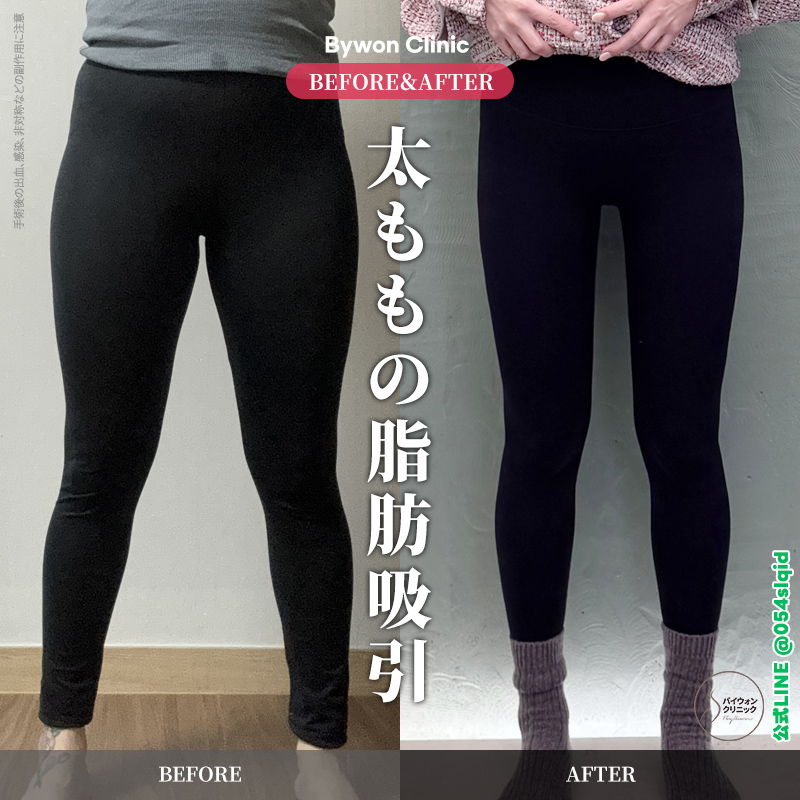 【韓国脂肪吸引専門】バイウォンクリニック tweet media